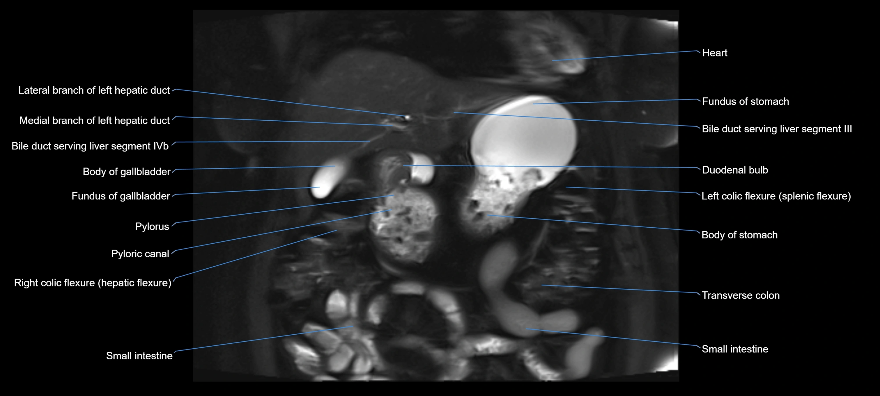 MRI MRCP coronal cross sectional 3T radiology  image-img-00001-00006.webp